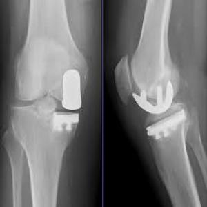 Arthroplasty-joint-replacement