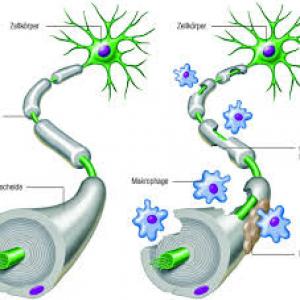 Multiple-sclerosis-MS
