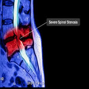 Spinal-stenosis