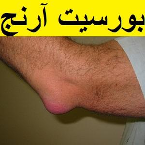 elbow-bursitis