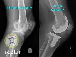 تعویض مفصل یا آرتروپلاستی Arthroplasty چیست؟