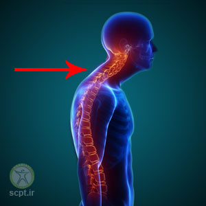 درمان کیفوز یا گرد پشتی تحت نظر دکتر فیزیوتراپیست