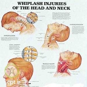 علائم درمان آسیب ویپلش شلاقی در تصادف-درد گردن-بهترین کلینیک فیزیوتراپی تهران