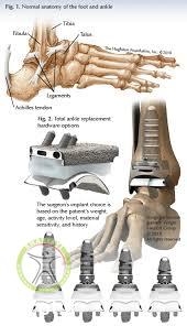 http://scpt.ir/uploads/Arthroplasty ankle.jpg
