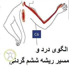 http://scpt.ir/uploads/Cervical-disc-herniation-treatment-at-home-pain-pattern-C6.jpg