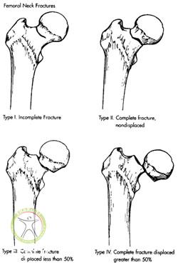 http://scpt.ir/uploads/Garden-classification-femoral-neck-fractures.jpg