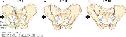 http://scpt.ir/uploads/Lateral compression fracture pelvic.jpg
