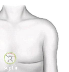 http://scpt.ir/uploads/Mastectomy_lyphotherapy-1.jpg