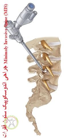 http://scpt.ir/uploads/Minimally-Invasive-Spine-(MIS)-Endoscopic-Spine-Surgery.jpg
