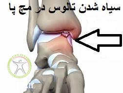 http://scpt.ir/uploads/Osteochondritis-Dissecans-OCD-Talus-ankle-1.jpg