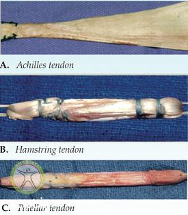 http://scpt.ir/uploads/acl-reconstruction-grafts.png