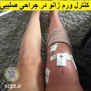 http://scpt.ir/uploads/acl-reconstruction-swelling.jpg