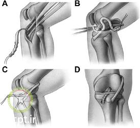 http://scpt.ir/uploads/acl-reconstruction-types-graft-iliotibial-band-techniques.png