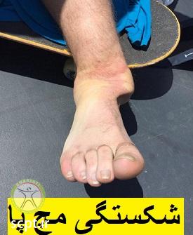 http://scpt.ir/uploads/ankle-fracture.jpg