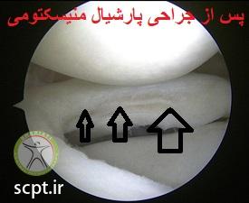 http://scpt.ir/uploads/arthroscopy-meniscus-tear-after-partial-menisectomy.jpg