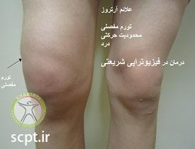 http://scpt.ir/uploads/arthrosis-Knee-effusion.jpg