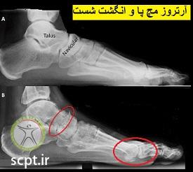 http://scpt.ir/uploads/arthrosis-ankle.jpg