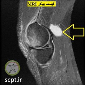 http://scpt.ir/uploads/bakers-cyst-MRI.jpg