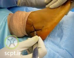 http://scpt.ir/uploads/calcaneus-Fractures-surgery.jpg