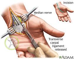 http://scpt.ir/uploads/carpal tunnel syndrome surgery.jpg