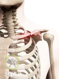 http://scpt.ir/uploads/clavicle-fracture-1.jpg