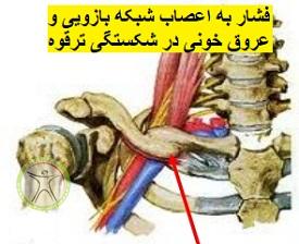 http://scpt.ir/uploads/clavicle-fracture-brachial.jpg