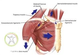 http://scpt.ir/uploads/clavicle-fracture-muscle.jpg