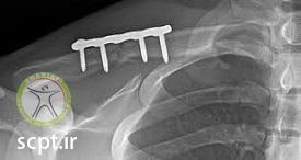 http://scpt.ir/uploads/clavicle-fracture-operation.jpg