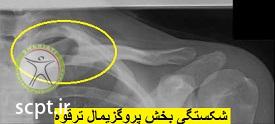 http://scpt.ir/uploads/clavicle_proximal-fracture.jpg