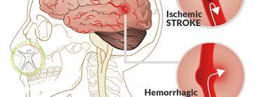 cva stroke hemorrhagic ischemic