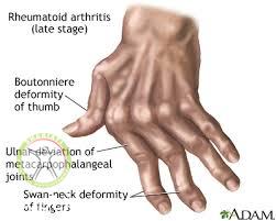 rheumatoid arthritis deformity