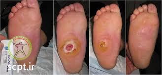 http://scpt.ir/uploads/diabetic foot laser therapy.jpg