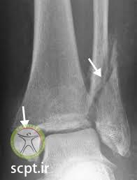 x ray double fracture ankle  
