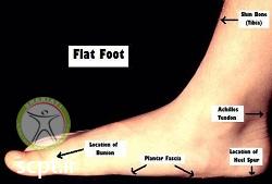 http://scpt.ir/uploads/flat-foot-signs-and-symptoms.jpg