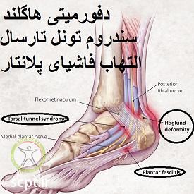 http://scpt.ir/uploads/foot-pain.jpg