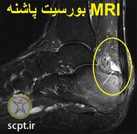 http://scpt.ir/uploads/heel-bursitis-achilles-bursitis-retrocalcaneal-bursitis-MRI.jpg