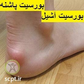http://scpt.ir/uploads/heel-bursitis-achilles-bursitis-retrocalcaneal-bursitis.jpg