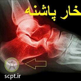 http://scpt.ir/uploads/heel-spur-physiotherapy-shariati-dr-rezaei-radiology.jpg
