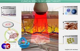 http://scpt.ir/uploads/high-power-laser-HPL-physiotherapy-pain-djd.jpg