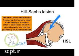 http://scpt.ir/uploads/hill-sachs-lesion-mechanism-1.jpg