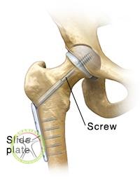 http://scpt.ir/uploads/hip-screw-femoral-fracture.jpg