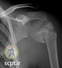 humeral head fracture