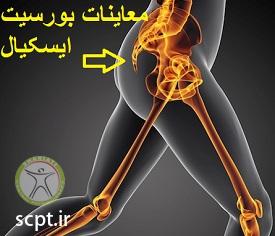 http://scpt.ir/uploads/ischial-bursitis-symptoms-pain-clinical.jpg