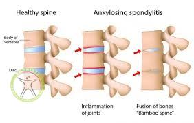 http://scpt.ir/uploads/low back pain Ankylosing spondylitis.jpg