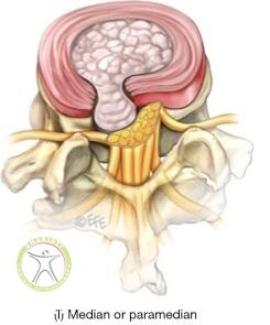 http://scpt.ir/uploads/low-back-pain-lumbar-disc-herniation-classification-central.jpg