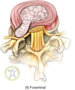http://scpt.ir/uploads/low-back-pain-lumbar-disc-herniation-classification-foraminal.jpg