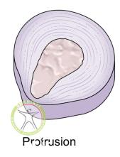 http://scpt.ir/uploads/low-back-pain-lumbar-disc-herniation-classification-protrusion.jpg
