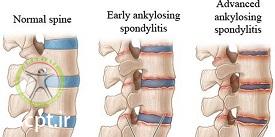 http://scpt.ir/uploads/low-back-pain-spondylitis-ankylosing.jpg