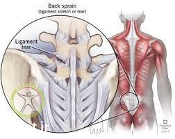 http://scpt.ir/uploads/lumbar pain ligamentous injury.jpg