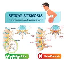 http://scpt.ir/uploads/lumbar pain spinal stenosis.jpg